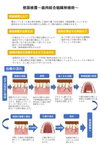 33.歯肉結合組織移植術CTGのサムネイル